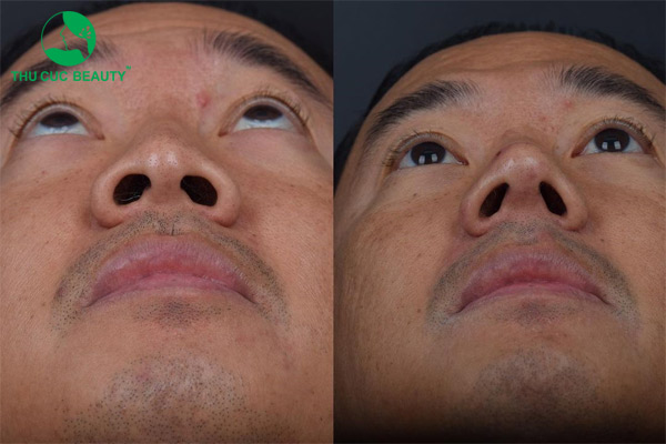 Thu gọn cánh mũi có vĩnh viễn không?