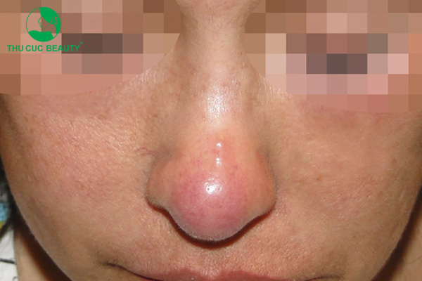 Thu nhỏ đầu mũi có bị to lại không?