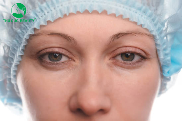 Có nên bấm mí lần 2? Khi nào nên nhấn mí mắt lần 2?