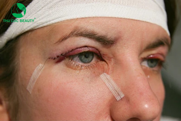 Cắt mí mắt xong bị ngứa có làm sao không?
