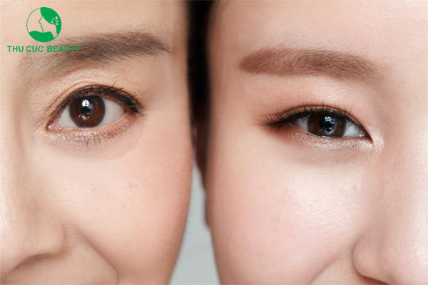 Cắt mí phượng hoàng là gì? Có tốt không?