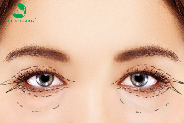 Cắt mí và mở góc mắt có gì khác nhau? Nên thực hiện loại nào