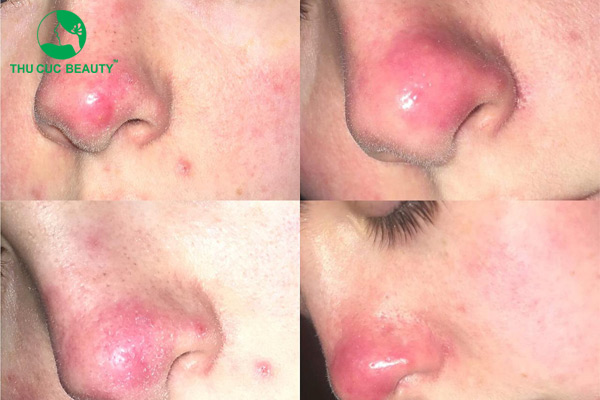 Đầu mũi to sau khi nâng mũi có đáng lo ngại?