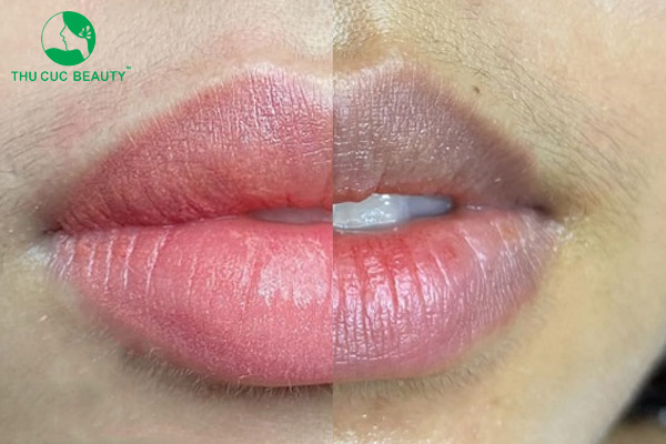 Khử thâm môi không phun màu là gì? Phù hợp với ai?