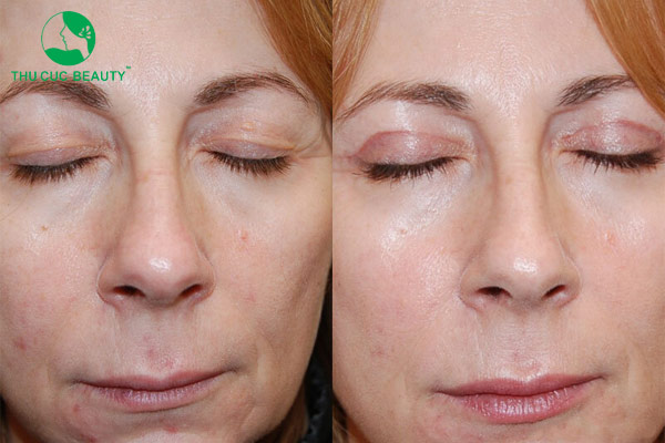 Vết cắt mí bị đỏ có nguy hiểm không?