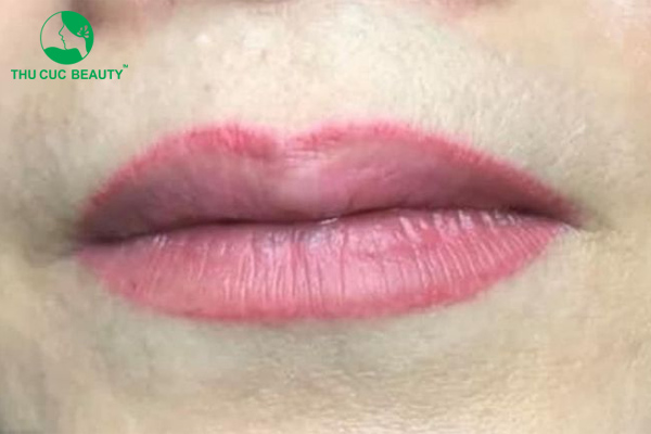 Bật mí 6 cách xử lý viền môi đậm hiệu quả