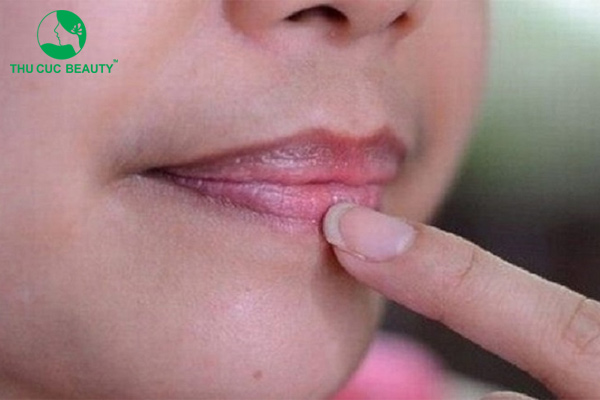 Môi thâm thiếu chất gì? 5 nguyên nhân gây thâm môi
