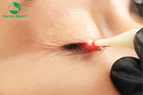 Xóa xăm mí mắt có nguy hiểm không?