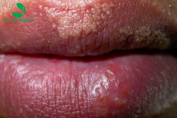 Môi bị hạt fordyce có phun môi được không?