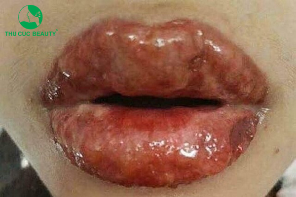 Dấu hiệu phun môi bị chảy nước mô và cách khắc phục