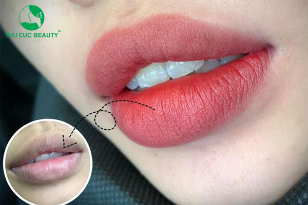 10 địa chỉ khử thâm môi uy tín ở Hà Nội và TP.HCM