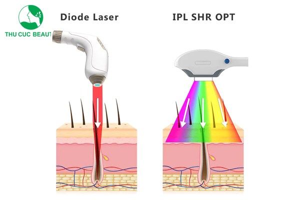 Điểm mạnh của kỹ thuật triệt lông Diode Laser