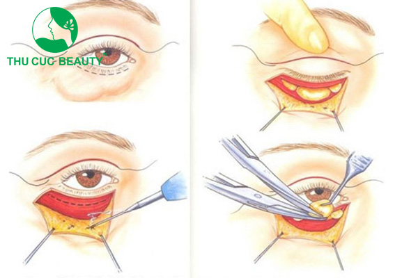 Quy trình xóa rãnh lệ