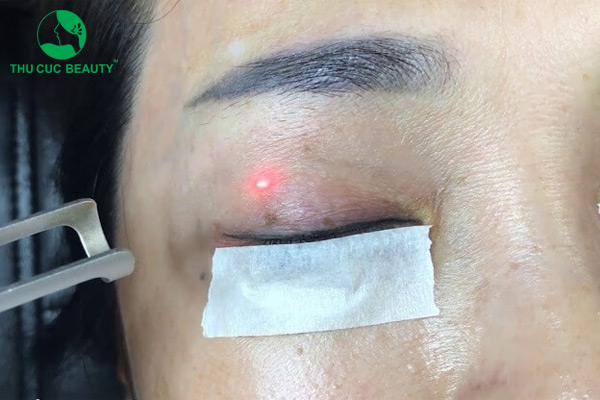 Xóa xăm mí mắt có đau không?