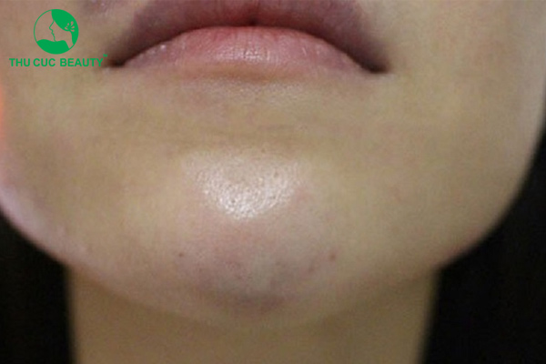 Tiêm filler xong bị cứng