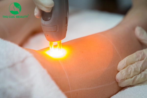 Triệt lông có hại không? Phương pháp triệt lông nào an toàn nhất?