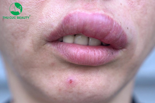 Dấu hiệu tiêm filler hỏng cần chú ý!