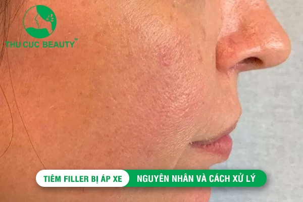 Tiêm Filler bị áp xe