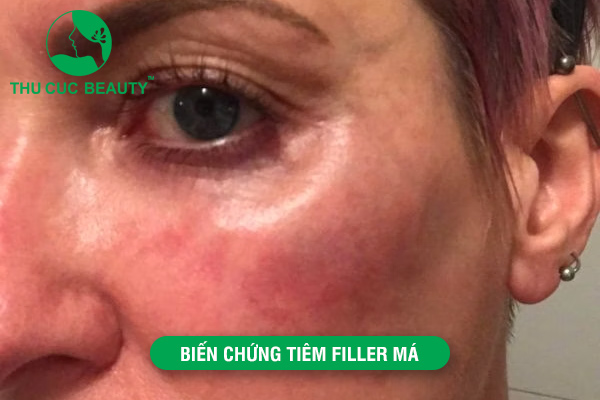 biến chứng tiêm filler má