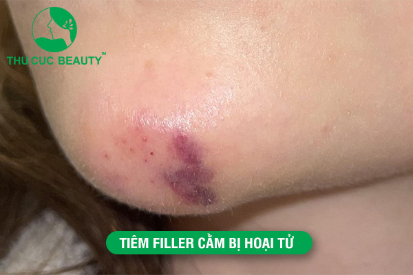 Tiêm filler cằm bị hoại tử