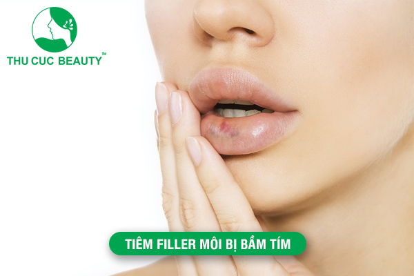 Tiêm filler môi bị bầm tím