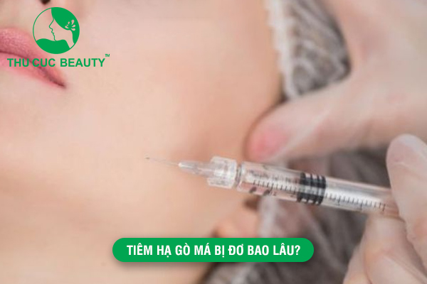 Tiêm hạ gò má bị đơ bao lâu?