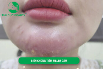 Biến chứng tiêm filler cằm: Nguyên nhân và cách khắc phục