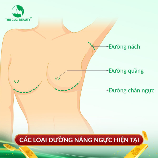 các đường nâng ngực