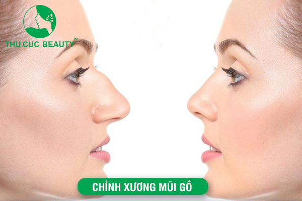 Chỉnh xương mũi gồ là gì?