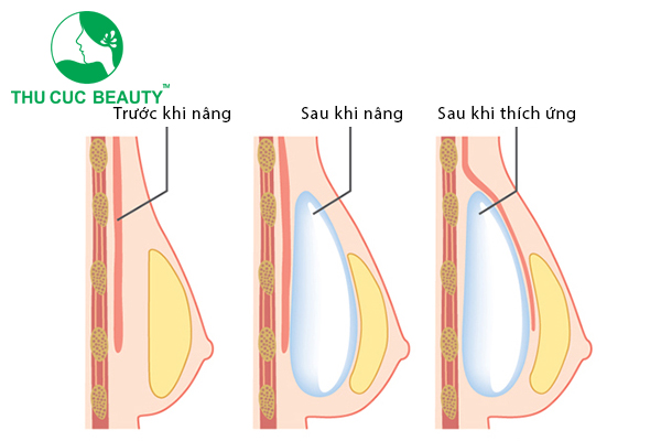 Nâng ngực là gì? Các phương pháp nâng ngực hiện nay