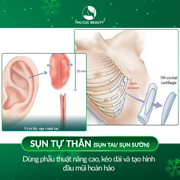 sụn tự thân nâng mũi