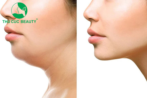 Trước và sau khi tiêm Filler cằm