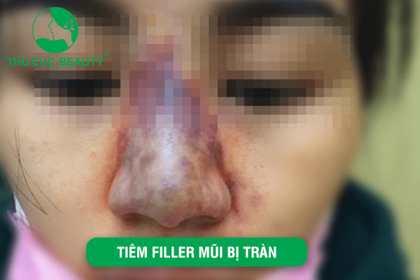 Tiêm Filler mũi bị tràn