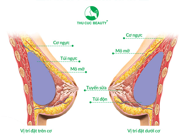 vị trí đặt túi ngực