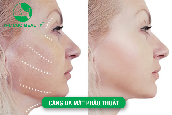 Căng da mặt phẫu thuật là gì?