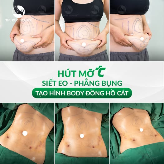 Hút Mỡ TC - Hút Mỡ Bằng Công Nghệ Vaser Lipo 4 hut mo bung an toan