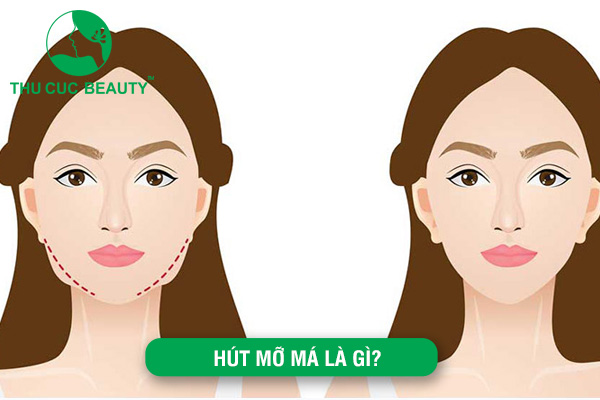 Hút mỡ má: Phương pháp sở hữu gương mặt thon gọn