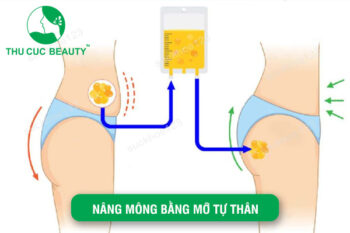 Nâng Mông Bằng Mỡ Tự Thân: Hút Mỡ Nâng Mông An Toàn