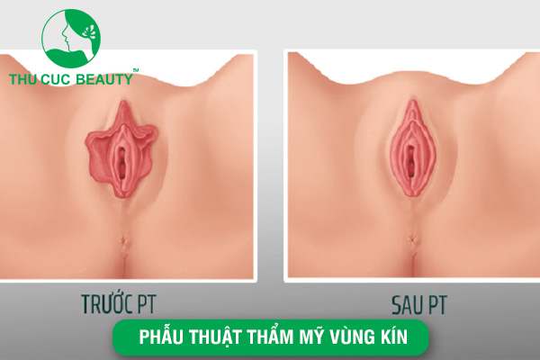 Phẫu thuật thẩm mỹ vùng kín