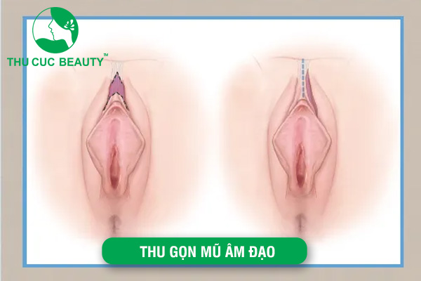 Thu gọn mũ âm vật