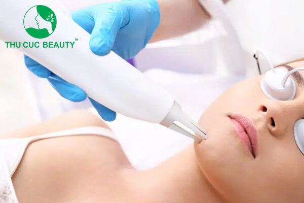 Đốt nốt ruồi bằng laser