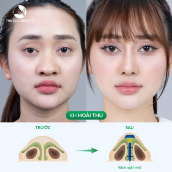 Thu nhỏ đầu mũi đẹp tự nhiên, an toàn