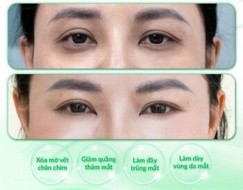 Cấy mỡ hốc mắt sâu tìm lại vẻ đẹp thanh xuân