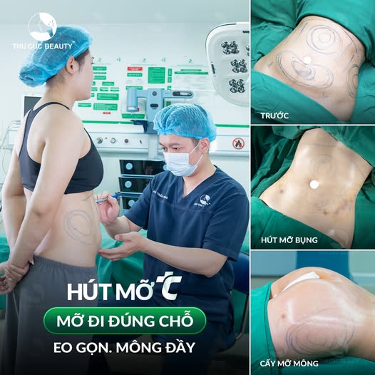 Quy trình cấy mỡ hóp mông