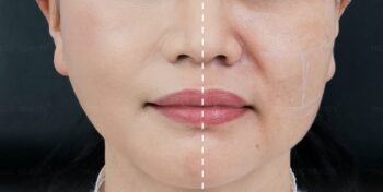 Cấy mỡ rãnh mũi má đẩy lùi lão hóa