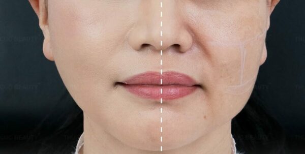 Cấy mỡ rãnh mũi má giúp lấy lại gương mặt trẻ trung.