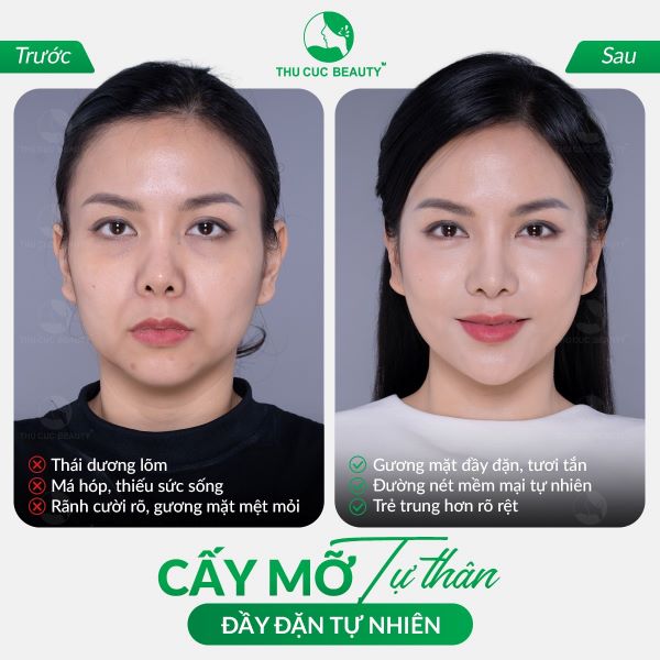 Cấy mỡ toàn mặt giúp thăng hạng nhan sắc một cách tự nhiên, trẻ hóa hiệu quả.
