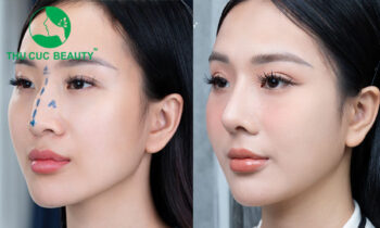 Chỉnh xương mũi gồ tạo góc nghiêng thanh thoát