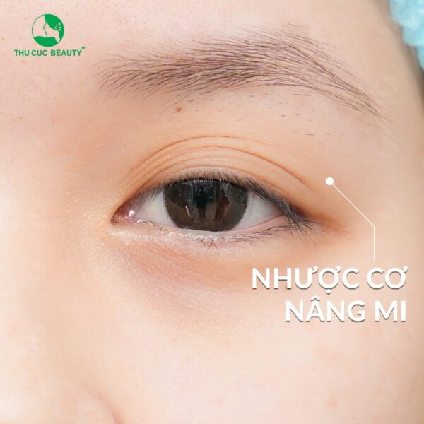 Dấu hiệu nhận biết tình trạng sụp mí mắt
