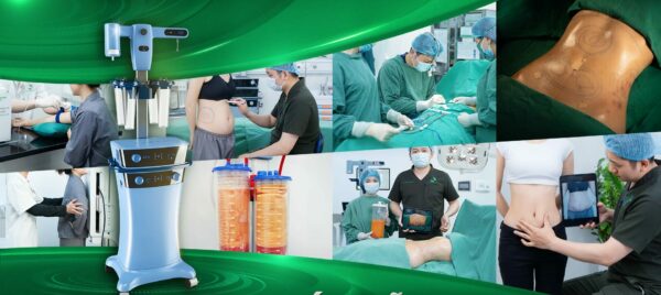 Quy trình hút mỡ chuyên nghiệp